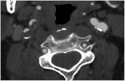 Association Between Carotid Artery Perivascular Fat Density and Embolic Stroke of Undetermined Source